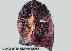 Emphysema V2 info stan