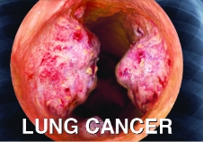 Lung Tumour info stan